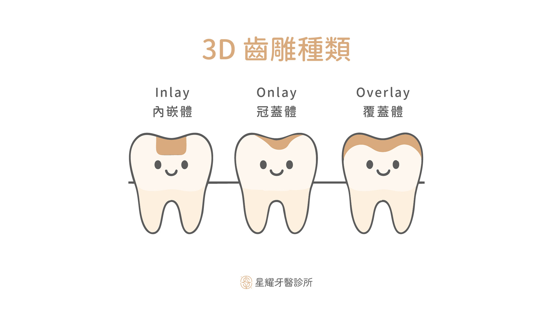 3D 齒雕種類