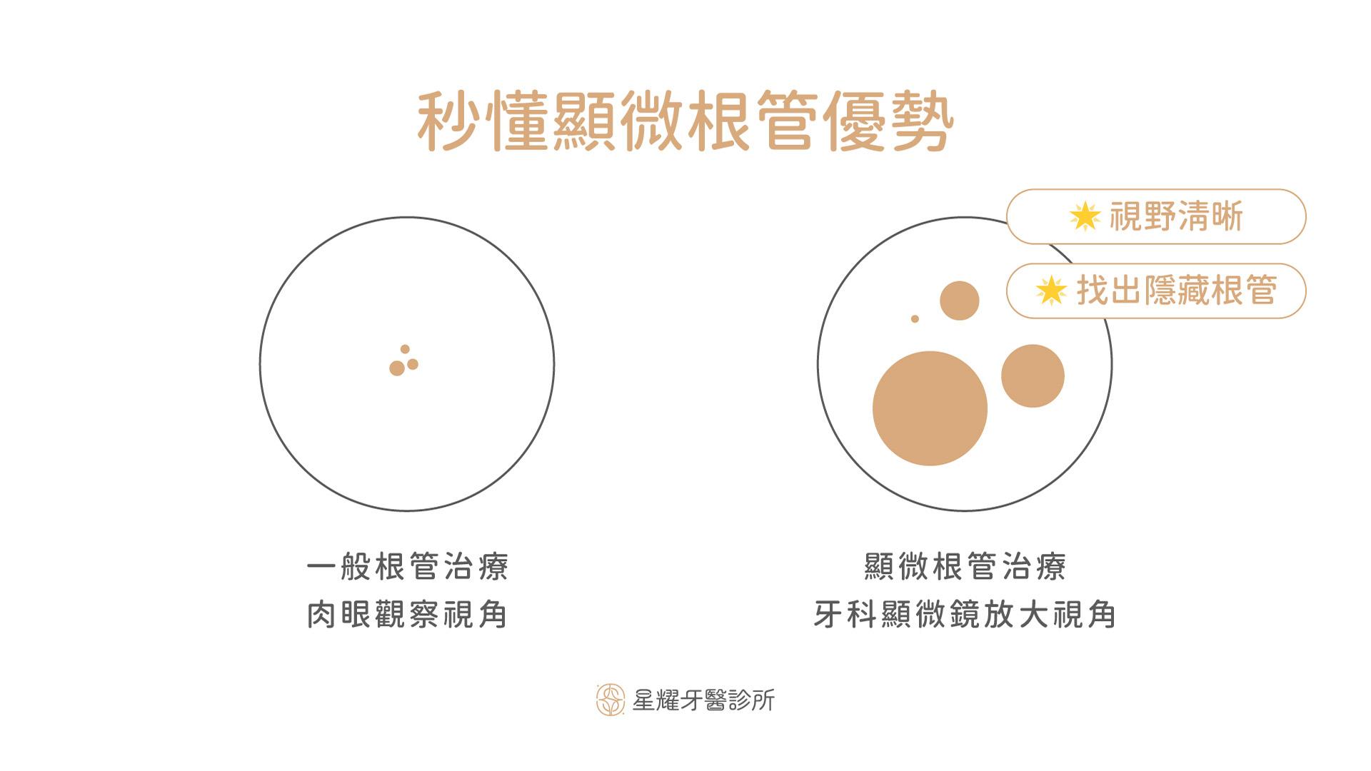 秒懂顯微根管優勢